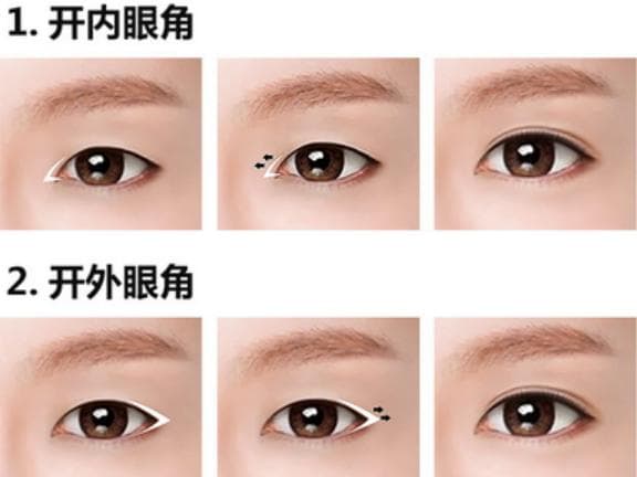 Illustration comparing inner eye-corner epicanthoplasty and outer eye-corner lateral canthoplasty.